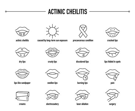 Actinic Cheilitis symptoms, diagnostic and treatment vector icon set. Line editable medical icons