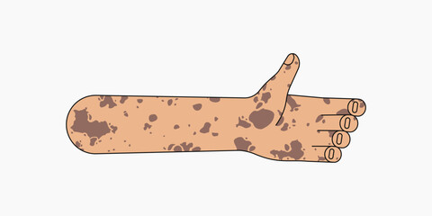 Vitiligo palm hand, gesture flat collage element vector