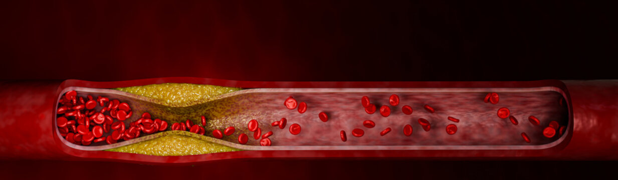 Hyperlipidemia or arteriosclerosis. Blocked artery concept and human blood vessel as a disease with cholesterol fat buildup clogging. Clogged arteries, Cholesterol plaque in the artery. 3D Rendering