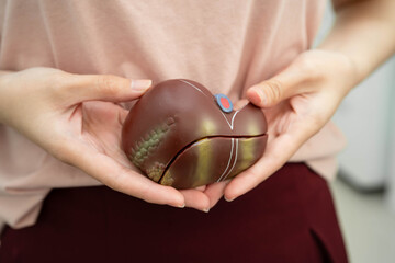 Cirrhosis, Liver cancer, fatty liver, Asian woman with liver human anatomy model.