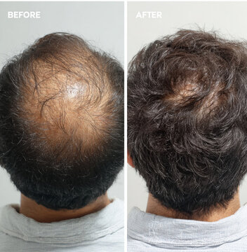Before and after images of the same person, from behind, hair regeneration treatment, "before" image, the hair is relatively thin,the photo on the right, the "after" image, the hair is much thicker
