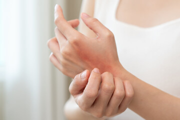 Close-up of young woman scratch her hand have a red rash
