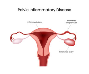 Pelvic Inflammatory Disease Anatomical Female Reproductive System