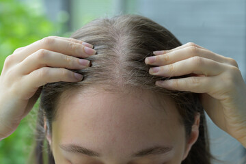 Fototapeta premium Close up of woman parting hair to reveal a dry, irritated scalp with visible flakes. Concept of scalp health, dermatology, dandruff, haircare, discomfort and sensitive skin condition.