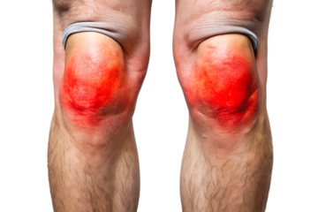 Closeup of inflamed knees with redness indicating potential injury arthritis or other medical condition on a transparent background