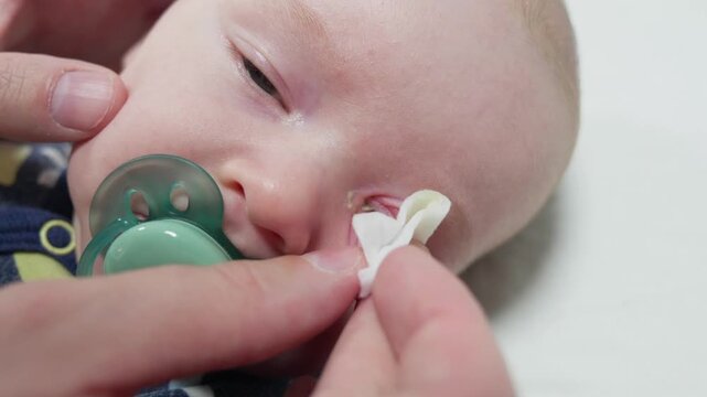 parent cleans eye mucus with a sterile cotton pad from baby eyes in selective focus. Disease tear ducts tons of newborns close up. blockage of the lacrimal drainage system. 