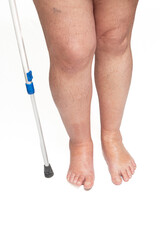 Swollen leg caused by a broken toe. Unrecognizable man with swollen feet, tired and painful...