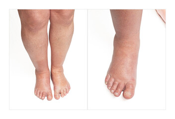 Collage of swollen legs caused by a broken toe. Unrecognizable man with swollen feet, tired and painful legs.Edema lower limbs
