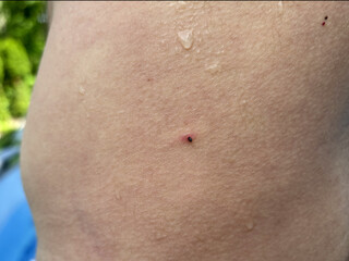 A Tick Embedded in a Mans Hip in Summer
