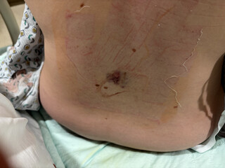 Fresh Epidural Injection for Pregnant Woman in Maternity Ward