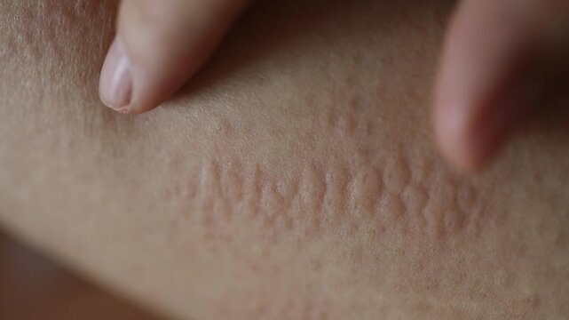 Close up image of skin texture suffering severe urticaria or hives or kaligata on leg. Allergy symptoms.