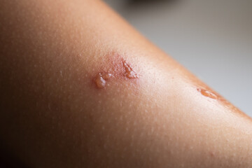 Close-up of Caucasian human skin with blisters and redness caused by minor burn injury, showing inflammation, irritation and damaged epidermis