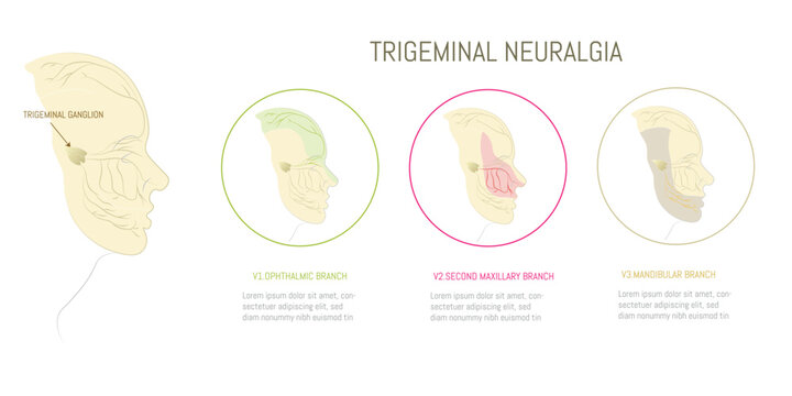 Trigeminal neuralgia branches showing ophthalmic, maxillary and mandibular nerves