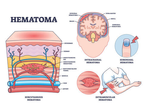Types of hematomas with labeled sections of skin, brain, and finger, highlighting blood accumulation. Outline diagram