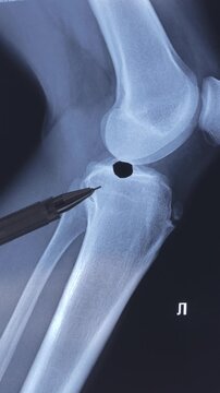 Vertical footage of doctor examining X-ray scan of knee joint. Exostosis on tibia. Cyst formation in the form of a Becker cyst.