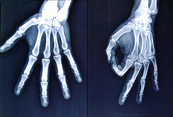 X ray film of hand showing fracture at the distal phalanx of  middle finger. Hand x ray. X ray...