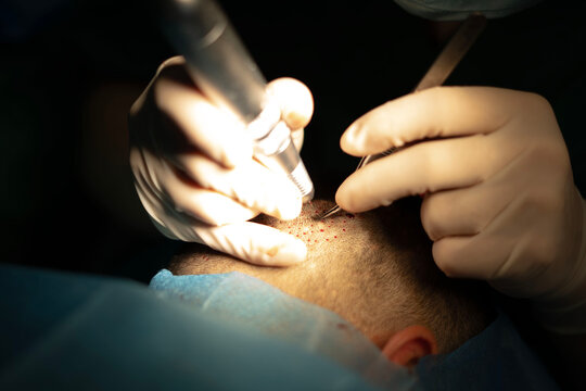 Hair transplant surgery