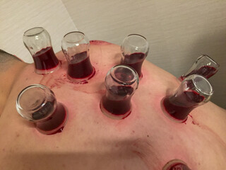 Glass Cupping Therapy with Blood — Traditional Hijama Treatment