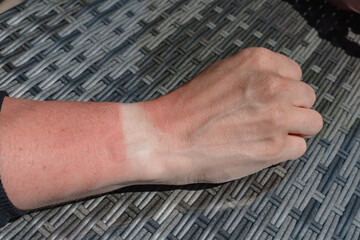 The man's tanned red hand, the white mark from the watch