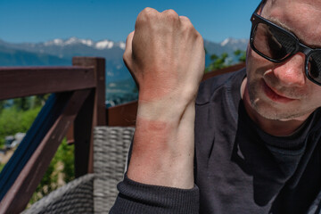 The man's tanned red hand, the white mark from the watch