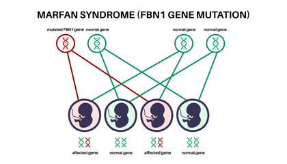 Marfan syndrome poster