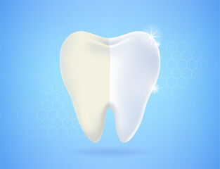 Half dirty yellow and whitening clean tooth isolated on bright blue background. Concept of healthy tooth, dental health, dentistry, hygiene toothbrush and toothpaste. Vector illustration.