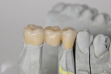 Close-up of a dental bridge spanning teeth 5 and 7, showcasing detailed prosthetic work. Concept of dental restoration, fixed bridge, and oral health care.