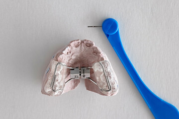 Close-up of an orthodontic palatal expander fixed on a dental cast, next to a blue key for activation. Used for upper jaw widening in orthodontic treatment.   © Tatiana