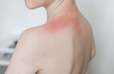 Fototapeta premium Preschool child with sun allergy and red burned skin on arm, shoulder, and chest. Small bumps and blisters under armpit. Kid scratching due to excessive sun exposure.