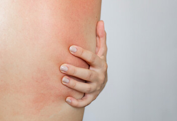 Woman with sunburned red back applying cream. Close view of irritated skin texture. Female forgot sunscreen while tanning. White background, skincare moment.