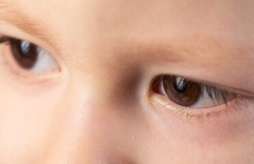 Fototapeta premium Bacterial infection in the eyes of a little boy, conjunctivitis, pus in the eyes, close-up