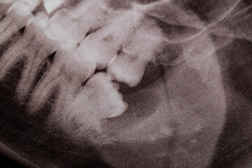 impacted wisdom tooth with a purulent cyst on x-ray, clse-up