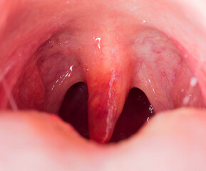 Uvulitis and sore throat in the oral cavity due to illness. Inflammation of the uvula and tonsils...
