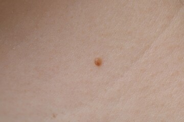 Woman with mole on her skin, macro view