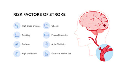 Brain neural disease for healthcare infographic. Vector flat illustration. Risk factors of stroke poster and icon set. Design for health care
