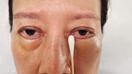 portrait the surgery plastic on the face, change and beauty concept, lifting and eyelid lift, Under eye fat removal and Reposition of the woman, Flabby skin and creases,health care and beauty concept.