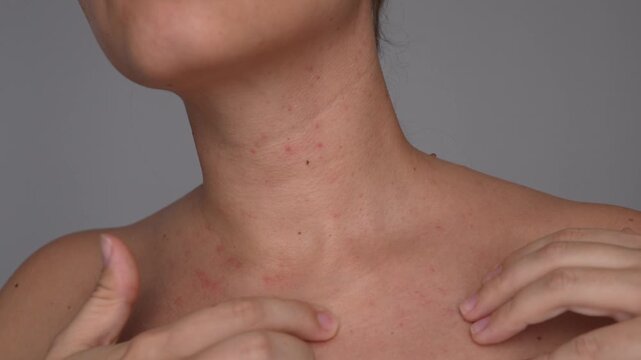 Close-up of a young woman touching the skin on her neck and chest affected by acne. A vulnerable and real moment reflecting common skin concerns and self-awareness