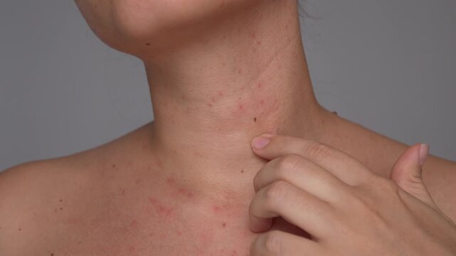 A young woman gently touches the red acne spots on her neck showing concern and sensitivity. A raw and relatable moment reflecting common skin issues and self-awareness. Acne problem