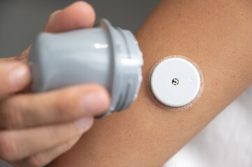 Patient inserting continuous glucose monitoring sensor on arm using applicator
