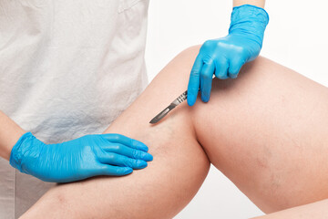 doctor shows  the dilation of small blood vessels of the skin on the leg. Medical inspection and treatment of Telangiectasia.