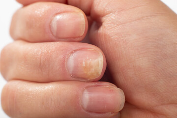 Psoriasis at the nail. Psoriasis is an autoimmune disease that affects the skin and nails. Close up