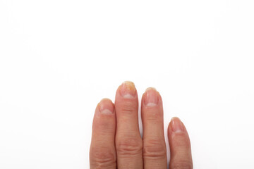 Psoriasis at the nail. Psoriasis is an autoimmune disease that affects the skin and nails. Close up