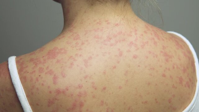 A woman with a red, spotty rash caused by measles.