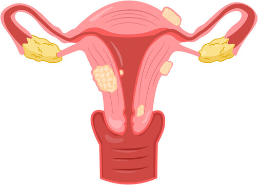 Uterine fibroids 