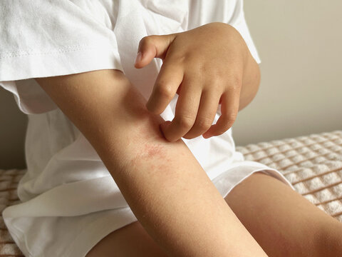 Child scratching irritated skin on arm due to rash or allergy