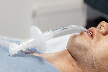 Patient receiving medical treatment with an airway management device, lying on a hospital bed, showcasing healthcare technology and patient care in a clinical environment