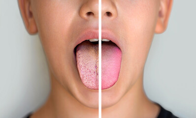 Result of cleaning the tongue. Child man tongue with a white plaque. Comparison of a diseased tongue with a white plaque and a healthy clean tongue before and after treatment
