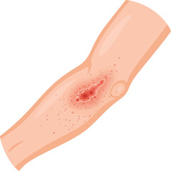 Illustration of skin rash on a human forearm, showing a red, inflamed area near the elbow.