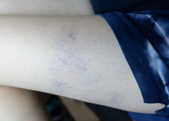 Close-up image of spider veins on a woman’s leg during a medical examination. Visible varicose...