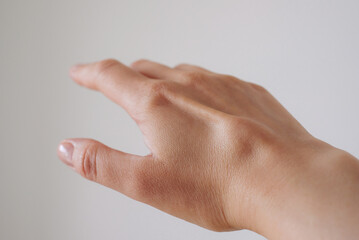 Female right back hand with ganglion cyst on the dorsum,  fluid-filled bump associated with a joint or tendon sheath, close-up view, selected focus.